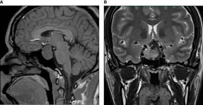 Observation of Clinicopathologic Features of Pituitary Adenoma With Neuronal Differentiation